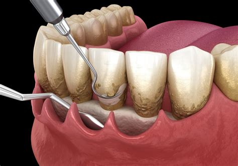 Periodontics .